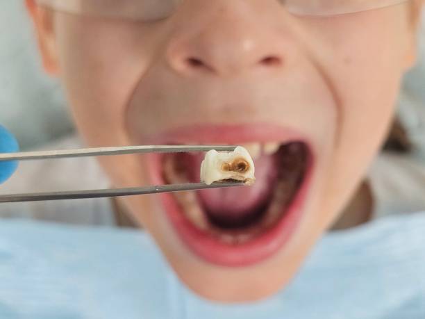 Best Emergency Dental Care for Abscessed Tooth in Marion, MS